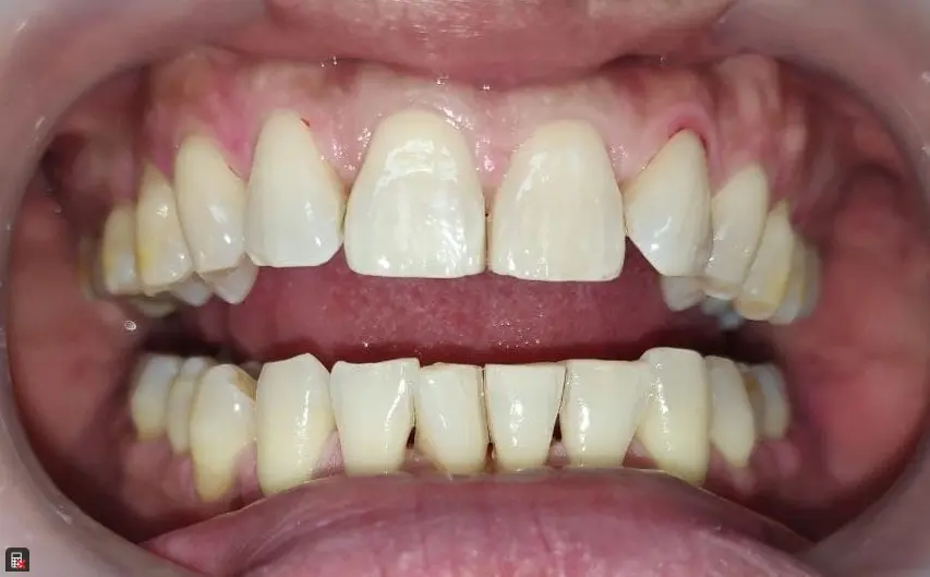 Adult Teeth After Guided Biofilm Therapy