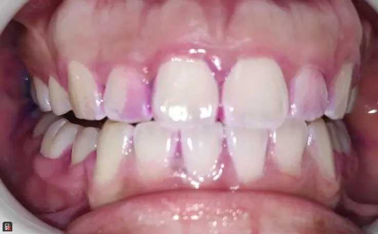 Teeth After Plaque Disclosed