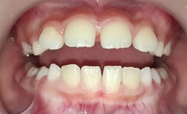 Child Teeth After Guided Biofilm Therapy