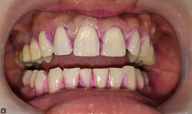 Adult Teeth After Plaque Disclosed