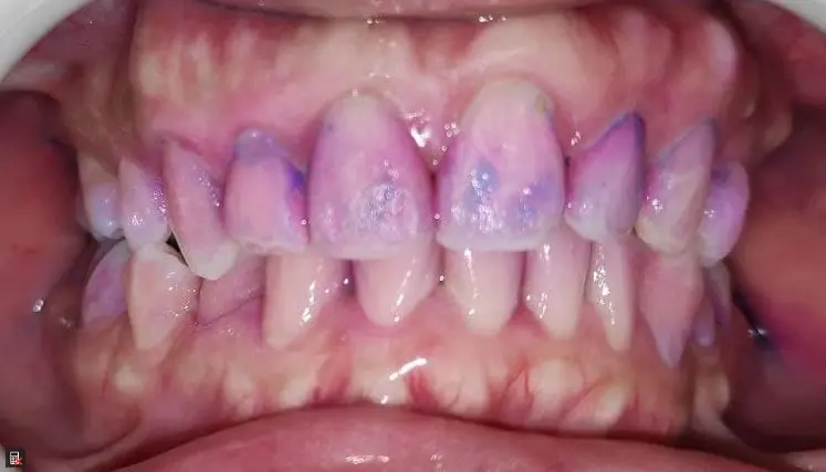 Adult Teeth After Disclosing Plaque