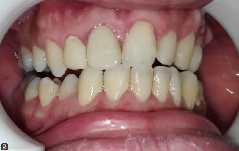 Adult Teeth Before Disclosing Plaque