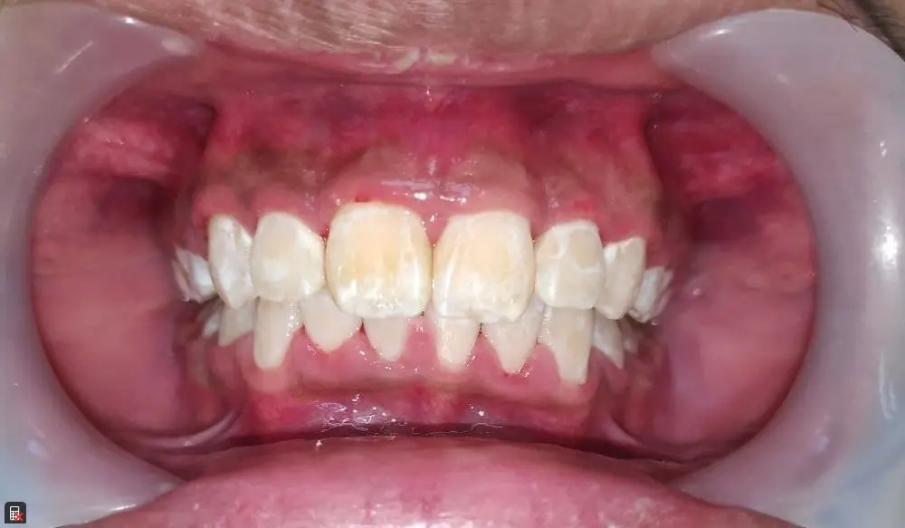 Ortho Debond