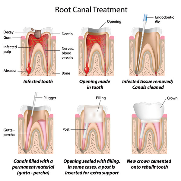 RCT Treatment