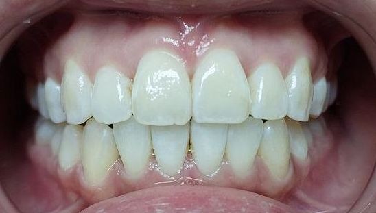 Aligner Final Visit