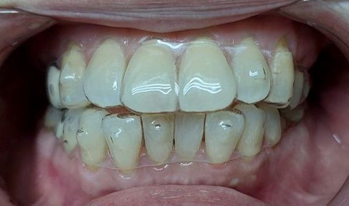 Reveal Aligner Fitting