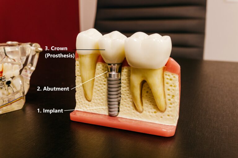 Dental Implant